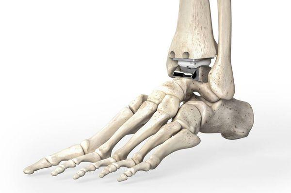 Ankle Replacement