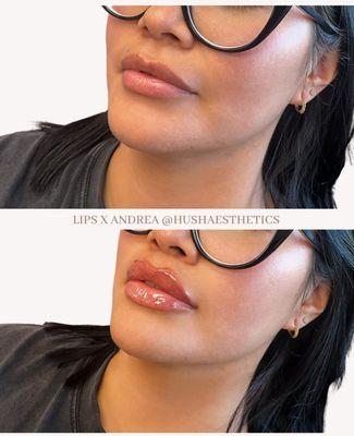 Lip filler with the goal of more height. Soft/medium Russian style lip. Goal: More height than projection