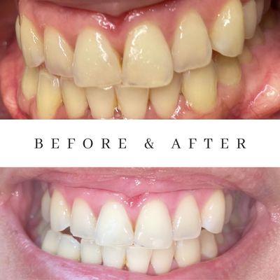 30min express teeth whitening with zero to very little sensitivity. 2-8 shades lighter guaranteed