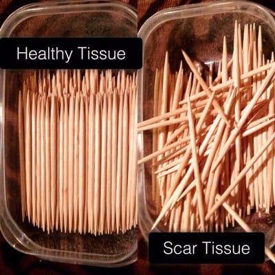 A simplified model of scar tissue from surgery or injury. The bodywork to reduce it is tough, but effective.