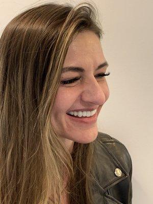 Custom 3 on 6 temporaries made exactly as patient wanted. Youthful, natural, and life-like contours.