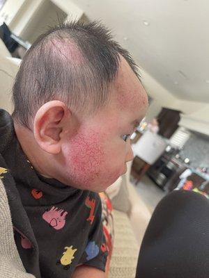 My sons cheek MORE irritated by the steroid they prescribed. They told me continue it but after I stopped it got BETTER! No thanks.