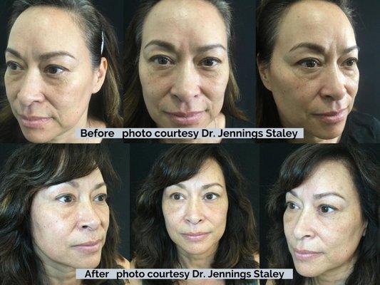 Fat Transfer by Dr. Staley