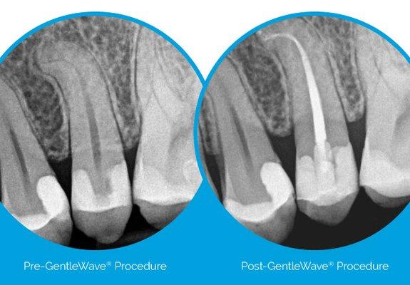 Dr. Adams' completed this case in ONE visit with our Sonendo GentleWave machine.
