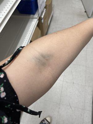bruising from misplacement of needle