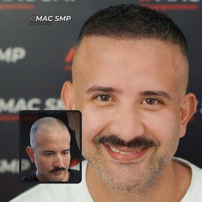 Smp is the only guaranteed hair loss solution. Contact me today!