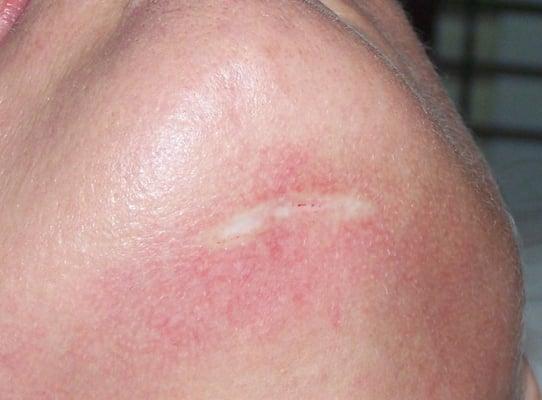 Scar before camouflage application