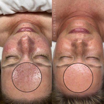 After te treatments & a customized skincare regimen