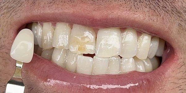 Note: I need cosmetic dental work on front tooth from an injury (that's why its still discolored).