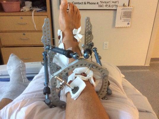 This is called an external fixation devise