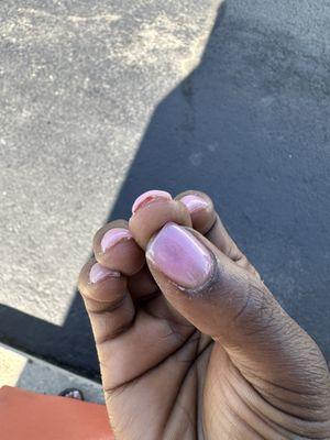 Bleeding from the lady pulling my skin back from the dried up gel