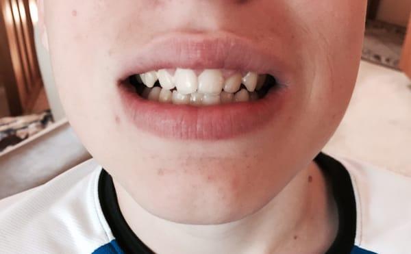 AFTER... You can't tell it was ever chipped. Smile restored!