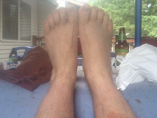 Which foot look swollen to you?
