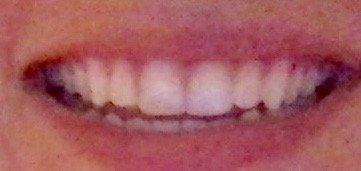 My teeth after 10 days of treatment