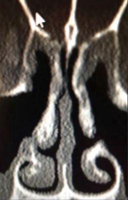 After my surgery with Joseph Raviv, where he negligently cut off airflow on the right side of my nose.