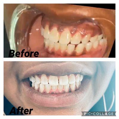 Instant whitening results in 1 hour and 30 minutes (3 sessions)