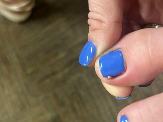 Infected toenail as described.