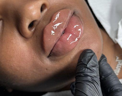 2ml lipfiller transformation