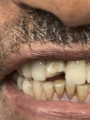 It fell off in 24 hours