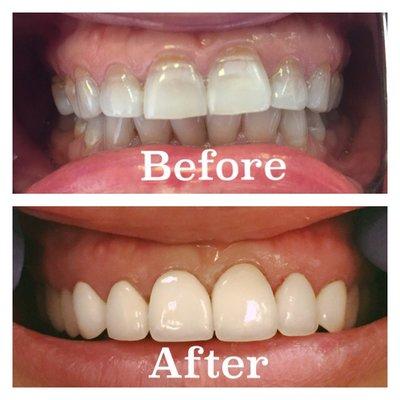 Prep-less Veneers
