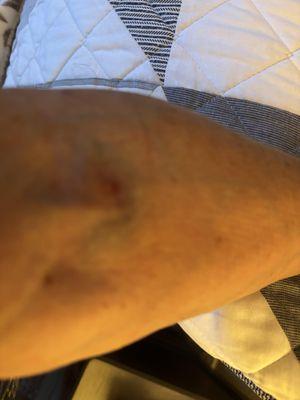 My bruised arm
