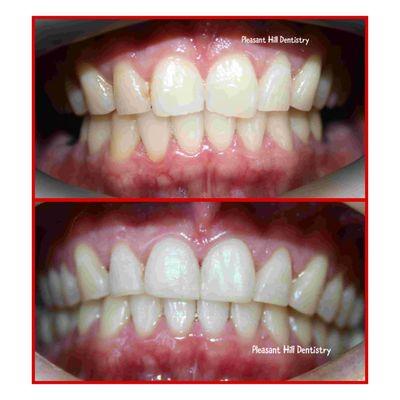 Before and after photos of an actual patient that has gone through Invisalign