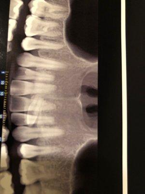 This was my problem I had an extra sideways tooth in the back of my two front ones!!!