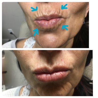 Filler to the lip lines