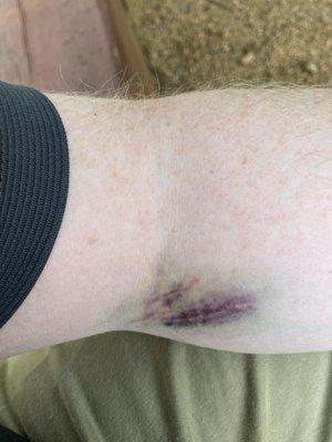 Track marks? Nope. This is from getting my blood sample taken from Quest Diagnostics inside Tom Thumb on Arapaho.