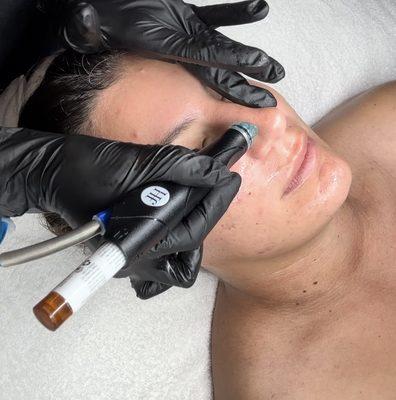 Hydrafacial.