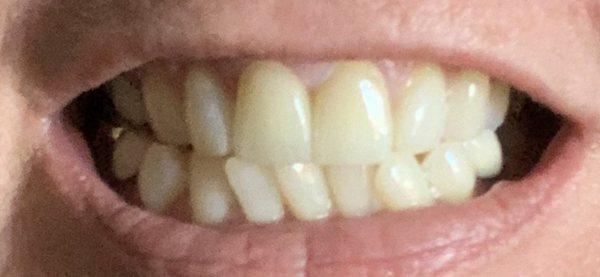 My two new front crowns! Thank you Dr.Teeth and your amazing team of professionals... You all really made me happy to smile again!