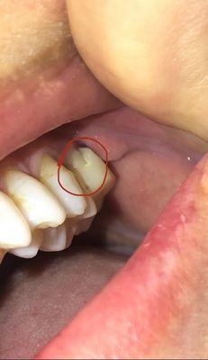 A broken temporary. It did not cover the tooth.