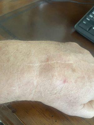 Scars from Eric the Butcher's botched surgery