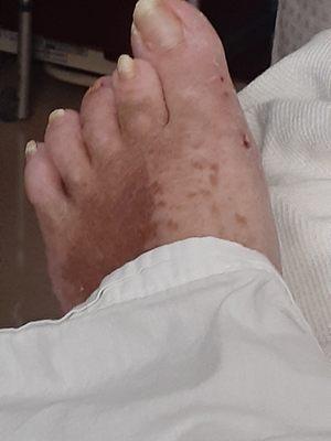 Lost a toe nail