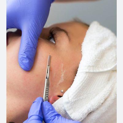 dermaplaning and dermabrasion are skin procedures done to improve the overall appearance of your skin. While both may help reduce fine line