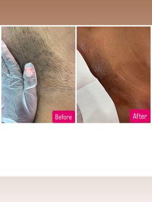 BEFORE & AFTER = BRAZILIAN