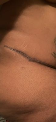 Scar to high up and it keloid