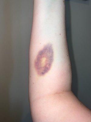 Bruise, right arm, with flash