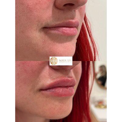 Lip Augmentation, immediately post injection, patient is swollen