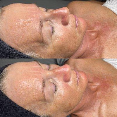 Before and After Geneo Revive Facial Treatment