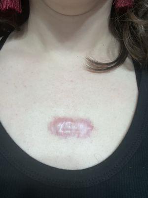 Keloid scar surgery 2 years post op
