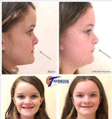 Amazing facial changes!!! TenBrook Orthopedics. Call 877-smile10 today, to discuss your child's early treatment.