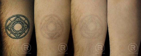 Renewal Laser Rochester