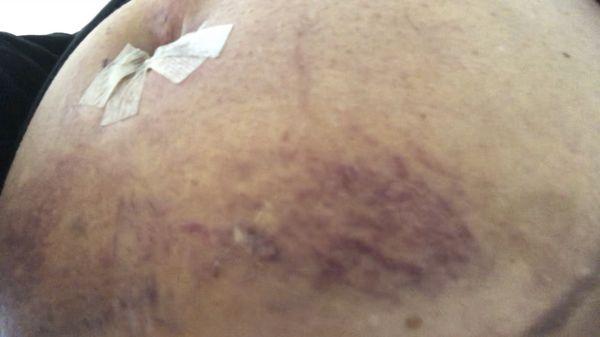 Wilson H. Hartz, III, MD, FACS