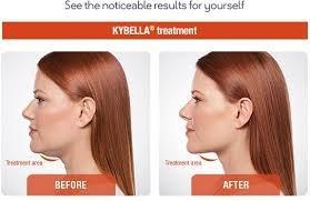Offering Kybella for that stubborn fat underneath your chin! Come in for a free consultation today!