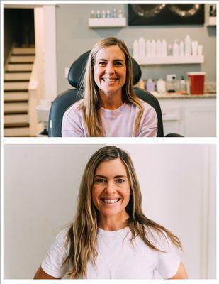 Before & after Toxin injections.