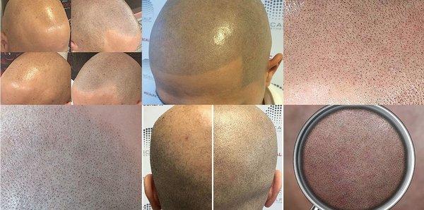 scalp micropigmentation