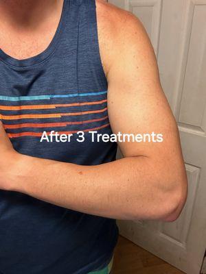 After 3 treatments
