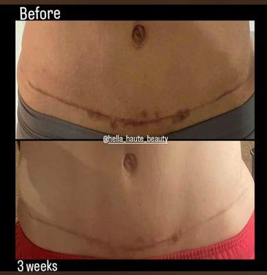 Tummy tuck scar camouflage This is a 3 weeks progress photo Healing results by 8 weeks