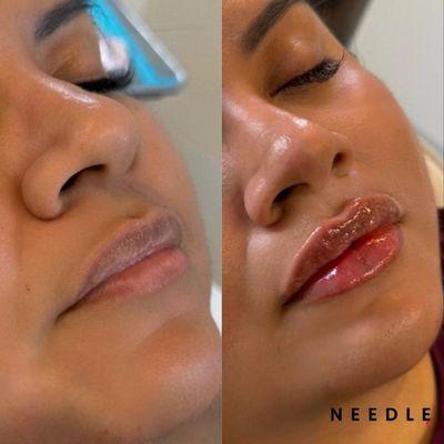 Needle Med Spa